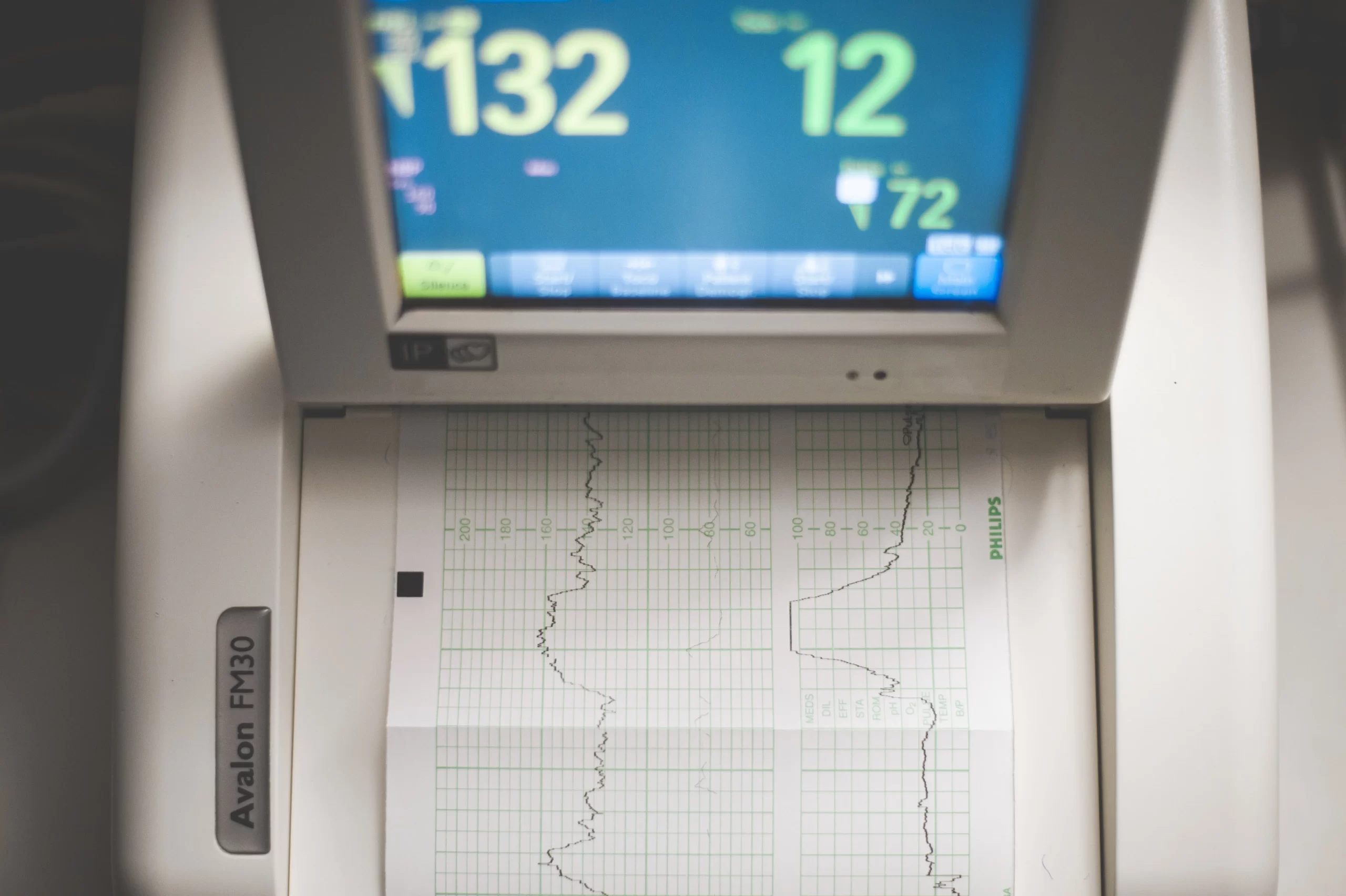 ECG: Everything You Need To Know About Electrocardiogram