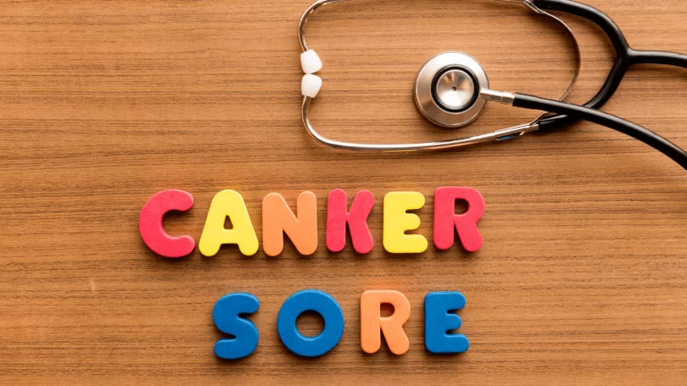 Canker sores – Causes, Symptoms, and Treatments