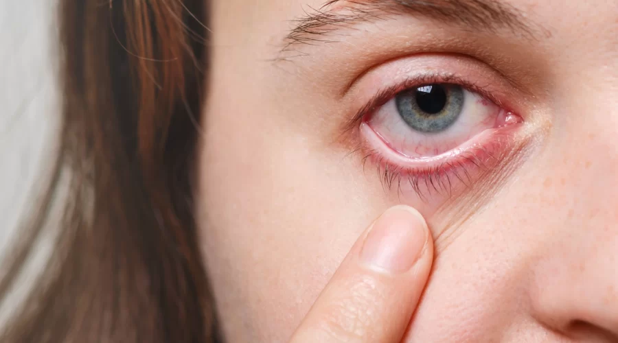Red eyes: causes, advice against eye irritation